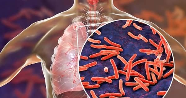 10 Interesting Facts About Tuberculosis (TB) Disease